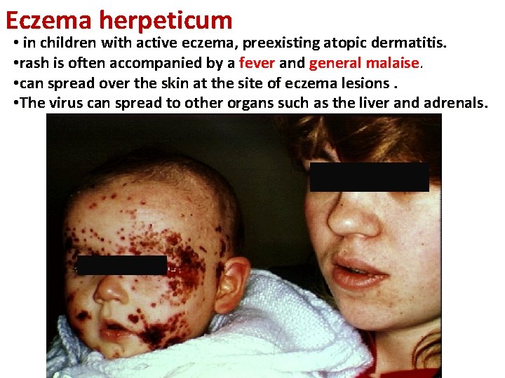 Eczema herpeticum • in children with active eczema, preexisting atopic dermatitis. • rash is