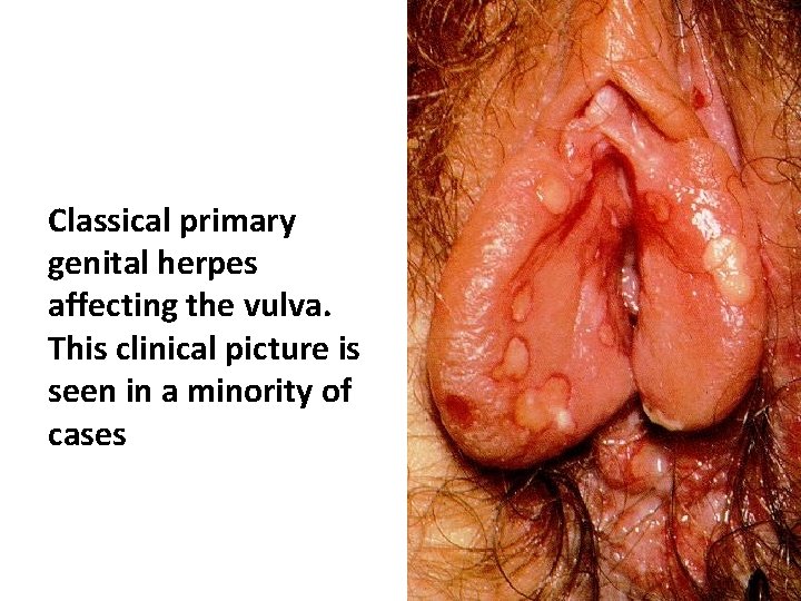 Classical primary genital herpes affecting the vulva. This clinical picture is seen in a