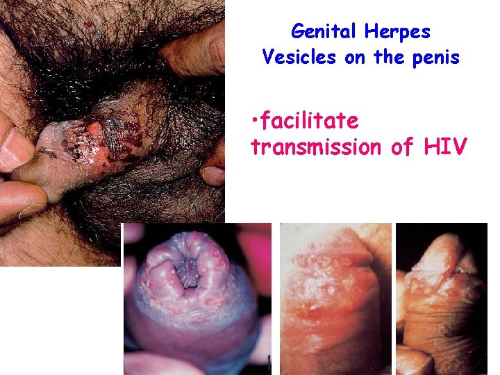 Genital Herpes Vesicles on the penis • facilitate transmission of HIV 