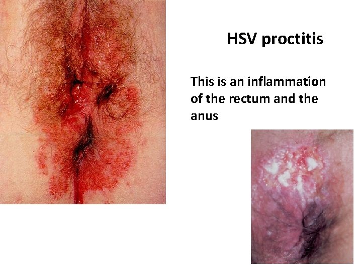 HSV proctitis This is an inflammation of the rectum and the anus 