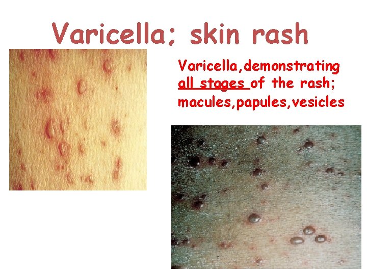 Varicella; skin rash Varicella, demonstrating all stages of the rash; macules, papules, vesicles 
