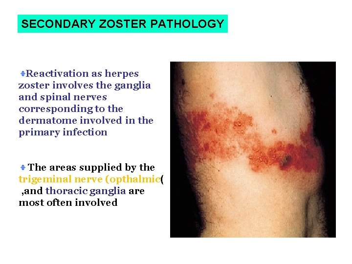 SECONDARY ZOSTER PATHOLOGY Reactivation as herpes zoster involves the ganglia and spinal nerves corresponding