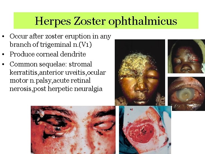 Herpes Zoster ophthalmicus • Occur after zoster eruption in any branch of trigeminal n.