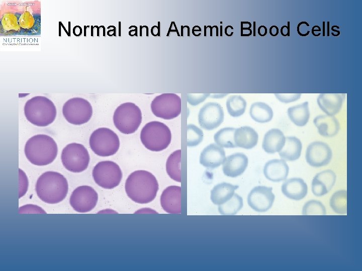Normal and Anemic Blood Cells 