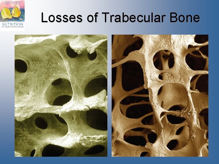 Losses of Trabecular Bone 