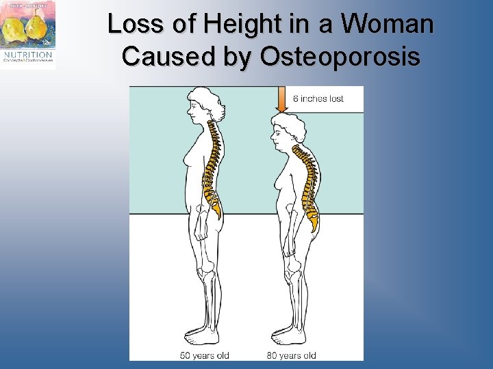 Loss of Height in a Woman Caused by Osteoporosis 