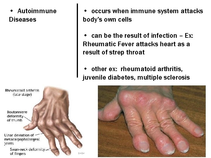  • Autoimmune Diseases • occurs when immune system attacks body’s own cells •