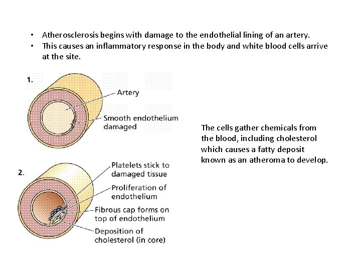  • Atherosclerosis begins with damage to the endothelial lining of an artery. •