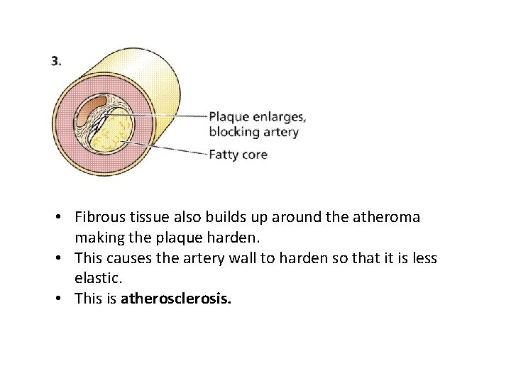  • Fibrous tissue also builds up around the atheroma making the plaque harden.