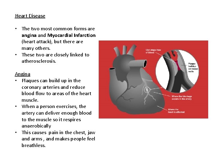 Heart Disease • The two most common forms are angina and Myocardial Infarction (heart