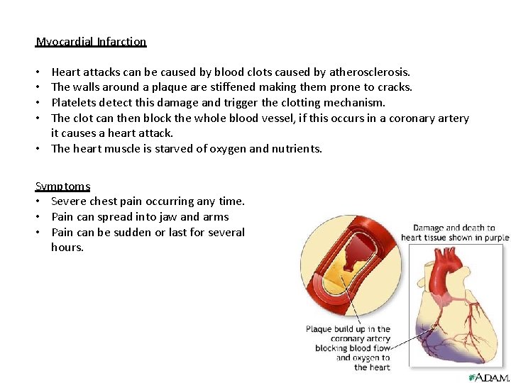 Myocardial Infarction Heart attacks can be caused by blood clots caused by atherosclerosis. The