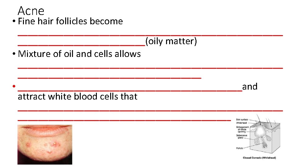 Acne • Fine hair follicles become __________________________(oily matter) • Mixture of oil and cells