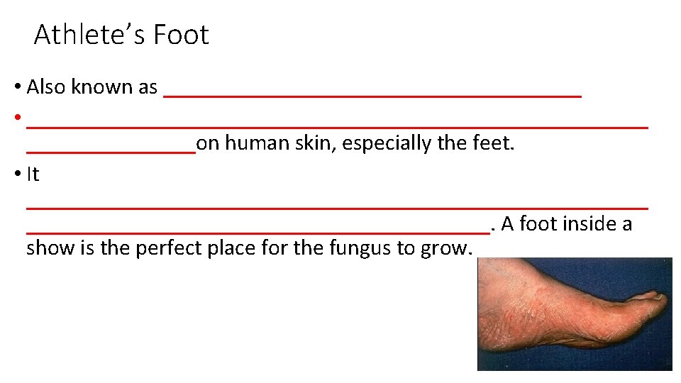 Athlete’s Foot • Also known as ___________________ • ____________________________on human skin, especially the feet.
