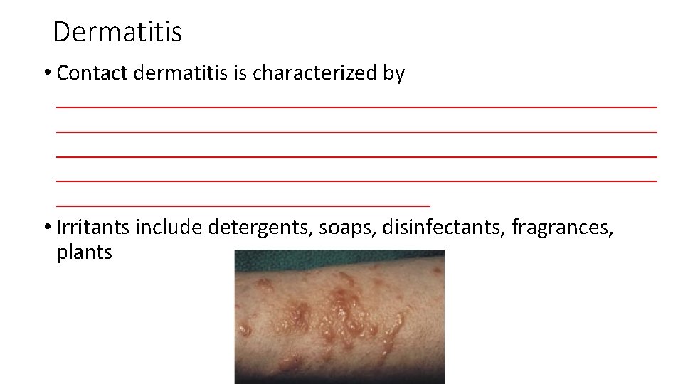 Dermatitis • Contact dermatitis is characterized by _____________________________________________________ _________________ • Irritants include detergents, soaps,