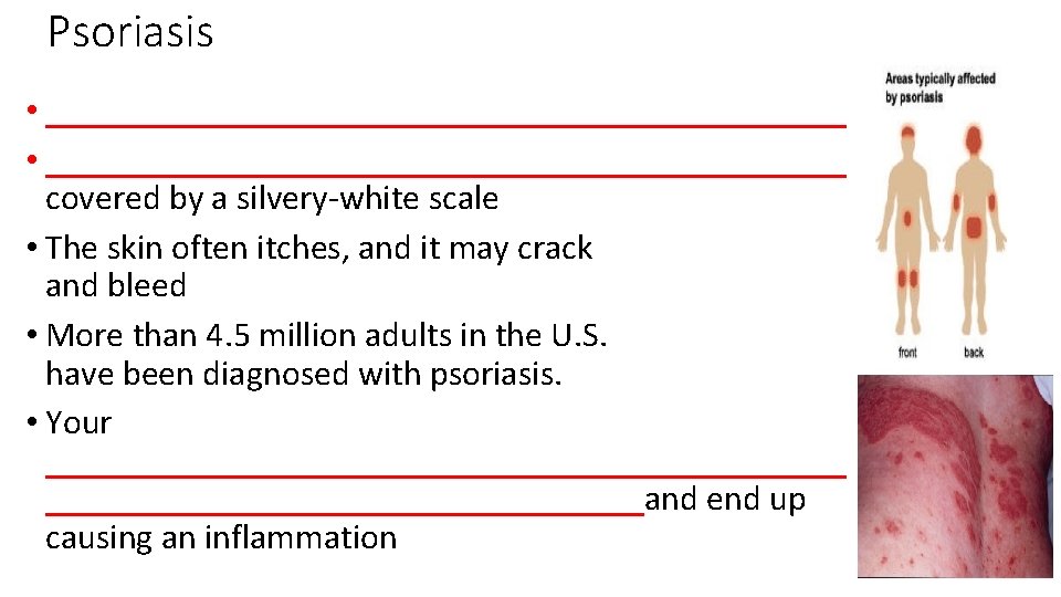 Psoriasis • ______________________________________________ covered by a silvery-white scale • The skin often itches, and
