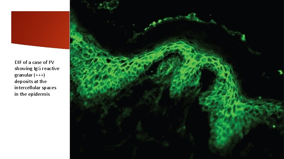 DIF of a case of PV showing Ig. G reactive granular (+++) deposits at