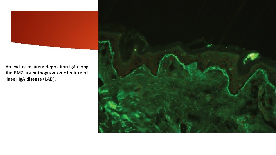 An exclusive linear deposition Ig. A along the BMZ is a pathognomonic feature of