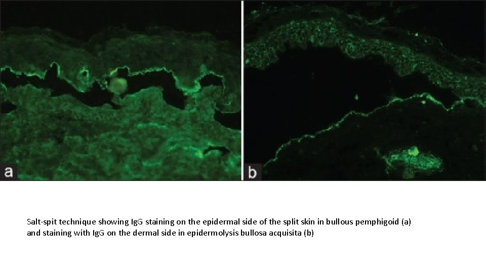 Salt-spit technique showing Ig. G staining on the epidermal side of the split skin