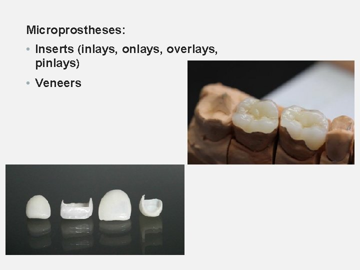 Microprostheses: • Inserts (inlays, overlays, pinlays) • Veneers 