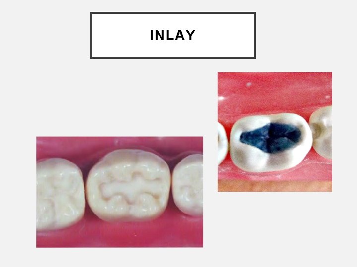 INLAY 