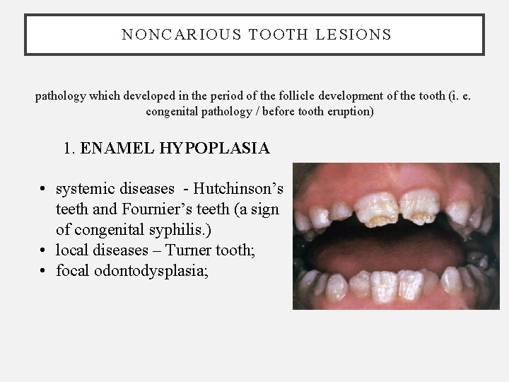 NONCARIOUS TOOTH LESIONS pathology which developed in the period of the follicle development of