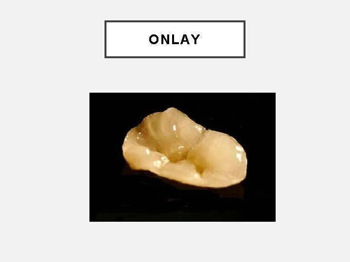 ONLAY 