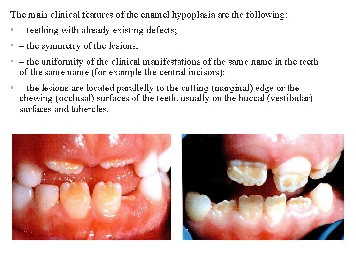 The main clinical features of the enamel hypoplasia are the following: • – teething