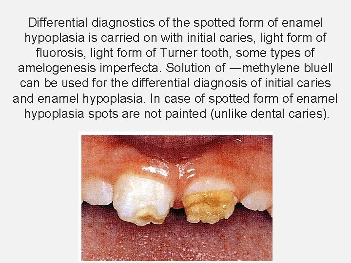Differential diagnostics of the spotted form of enamel hypoplasia is carried on with initial