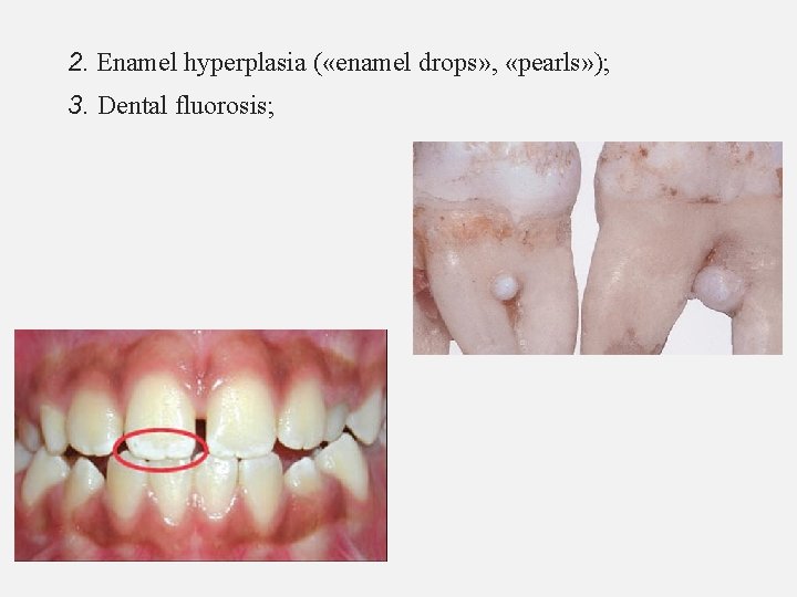 2. Enamel hyperplasia ( «enamel drops» , «pearls» ); 3. Dental fluorosis; 
