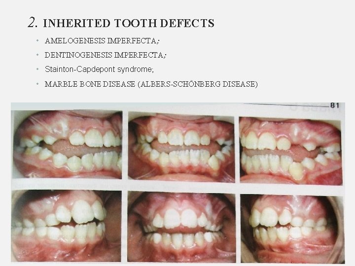 2. INHERITED TOOTH DEFECTS • AMELOGENESIS IMPERFECTA; • DENTINOGENESIS IMPERFECTA; • Stainton-Capdepont syndrome; •