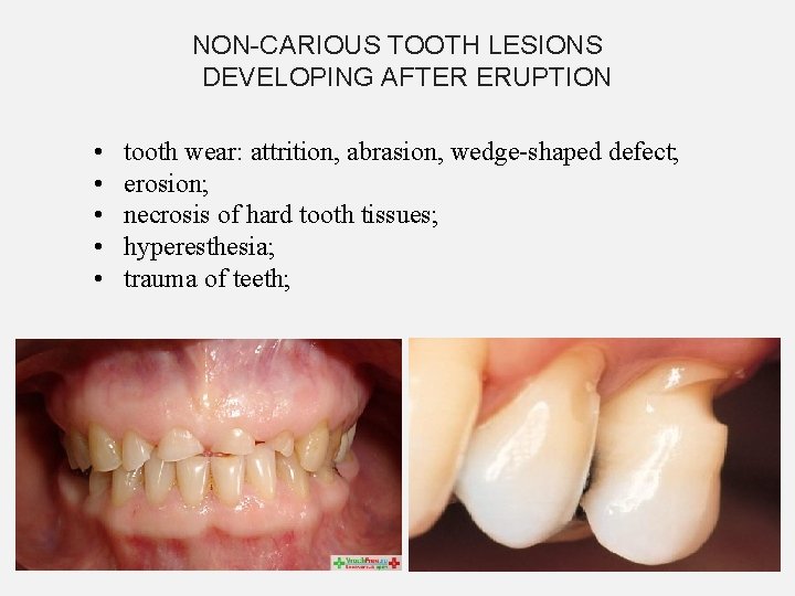 NON-CARIOUS TOOTH LESIONS DEVELOPING AFTER ERUPTION • • • tooth wear: attrition, abrasion, wedge-shaped