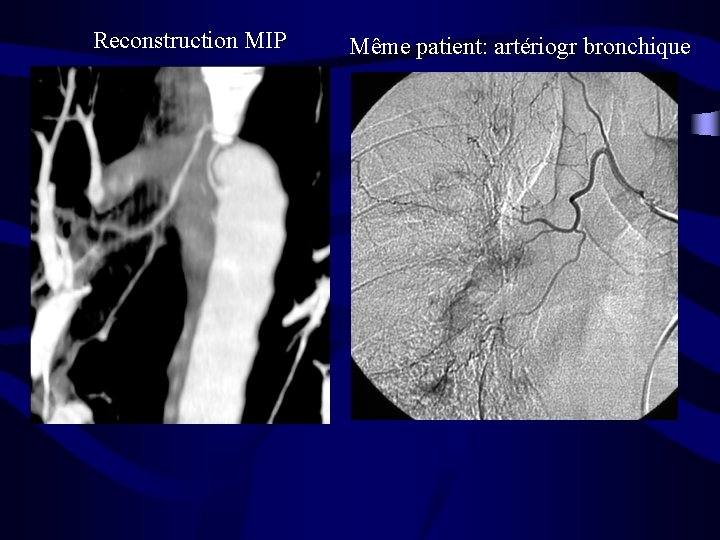 Reconstruction MIP Même patient: artériogr bronchique 