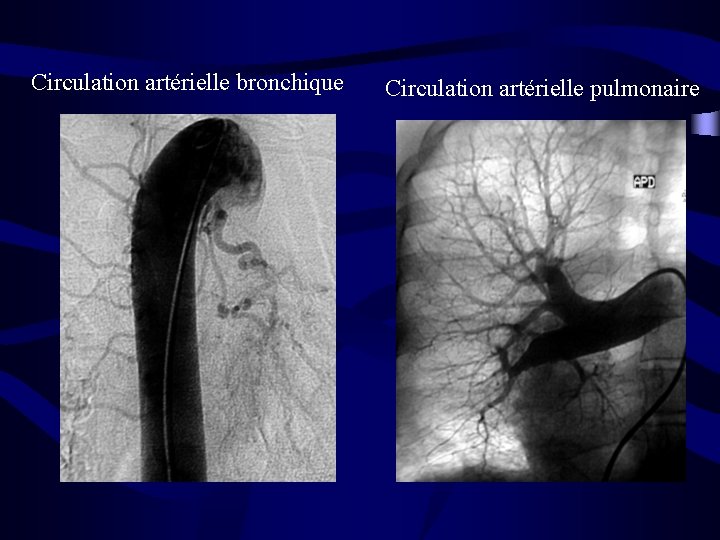 Circulation artérielle bronchique Circulation artérielle pulmonaire 