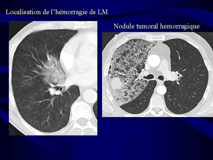 Localisation de l’hémorragie ds LM Nodule tumoral hemorragique 