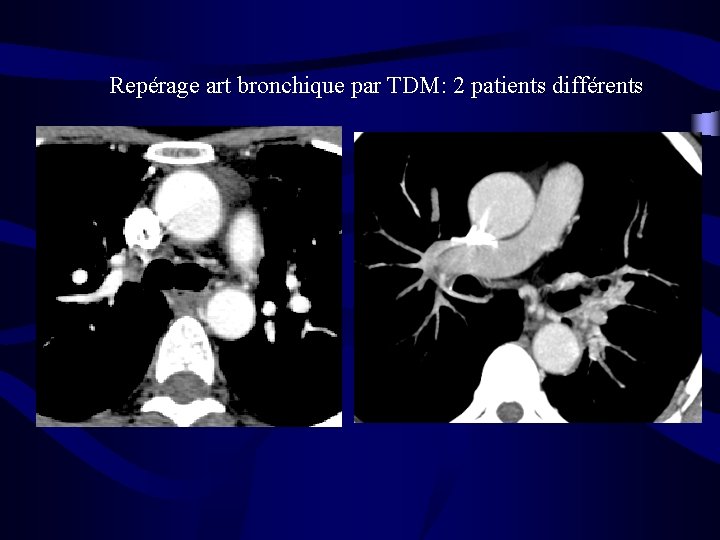 Repérage art bronchique par TDM: 2 patients différents 