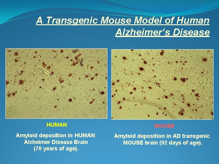 A Transgenic Mouse Model of Human Alzheimer’s Disease HUMAN Amyloid deposition in HUMAN Alzheimer