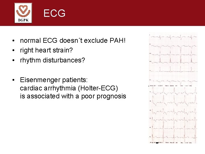 ECG • normal ECG doesn´t exclude PAH! • right heart strain? • rhythm disturbances?