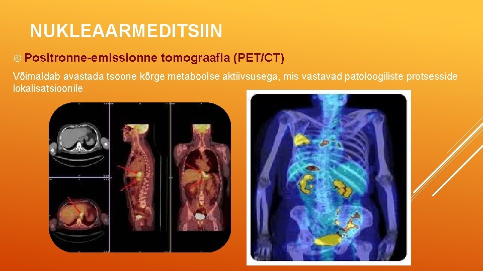 NUKLEAARMEDITSIIN Positronne-emissionne tomograafia (PET/CT) Võimaldab avastada tsoone kõrge metaboolse aktiivsusega, mis vastavad patoloogiliste protsesside