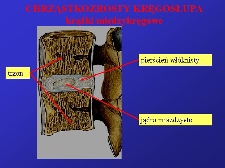 CHRZĄSTKOZROSTY KRĘGOSŁUPA krążki międzykręgowe pierścień włóknisty trzon jądro miażdżyste 