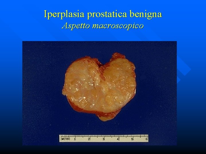 Iperplasia prostatica benigna Aspetto macroscopico 