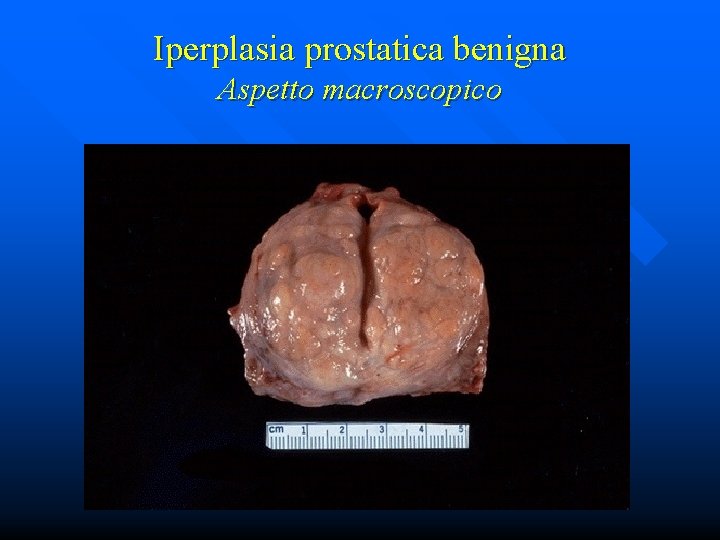 Iperplasia prostatica benigna Aspetto macroscopico 