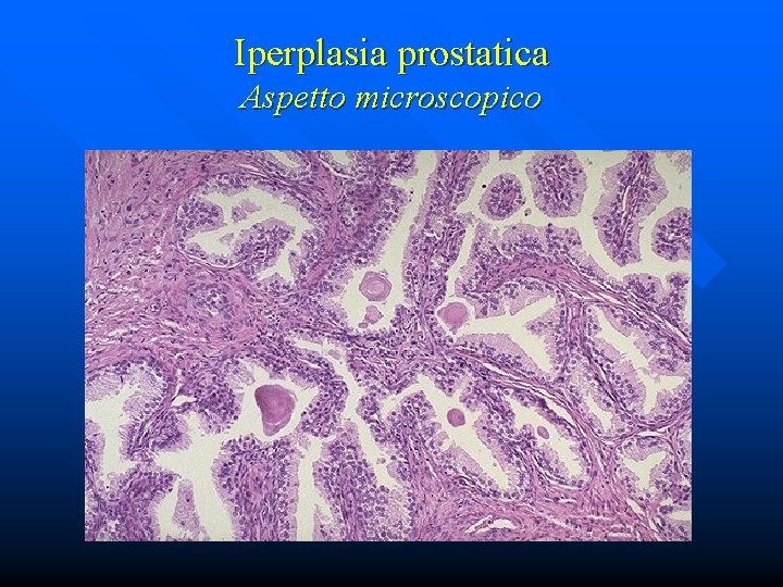 Iperplasia prostatica Aspetto microscopico 
