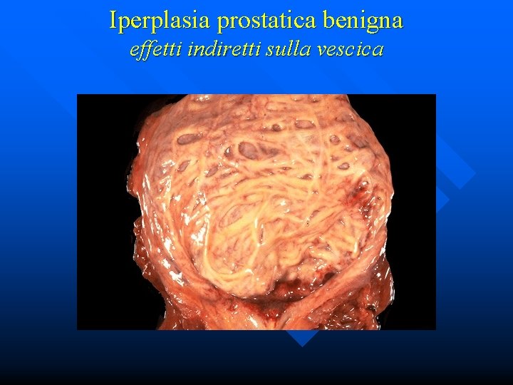 Iperplasia prostatica benigna effetti indiretti sulla vescica 