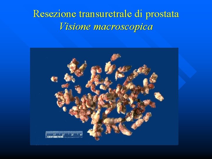 Resezione transuretrale di prostata Visione macroscopica 