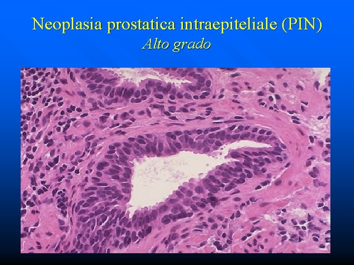 Neoplasia prostatica intraepiteliale (PIN) Alto grado 