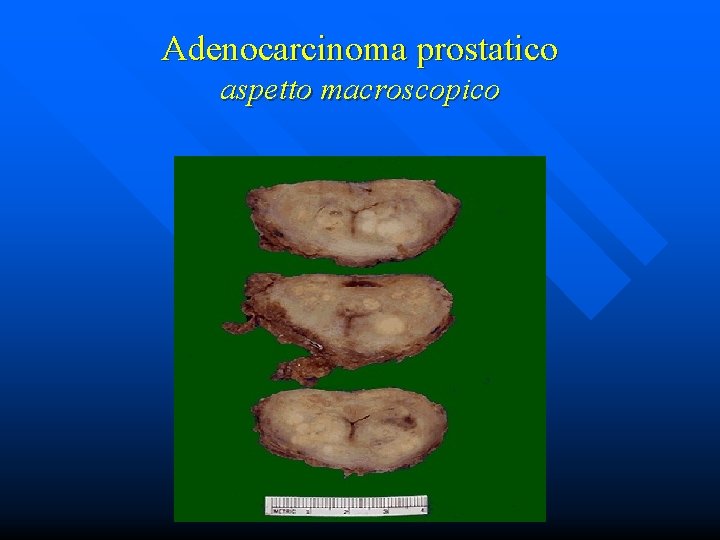 Adenocarcinoma prostatico aspetto macroscopico 