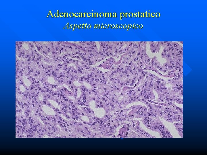 Adenocarcinoma prostatico Aspetto microscopico 