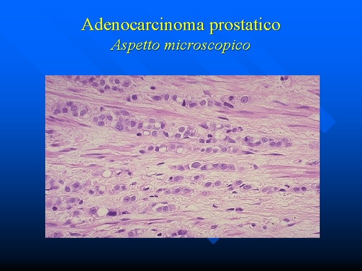 Adenocarcinoma prostatico Aspetto microscopico 