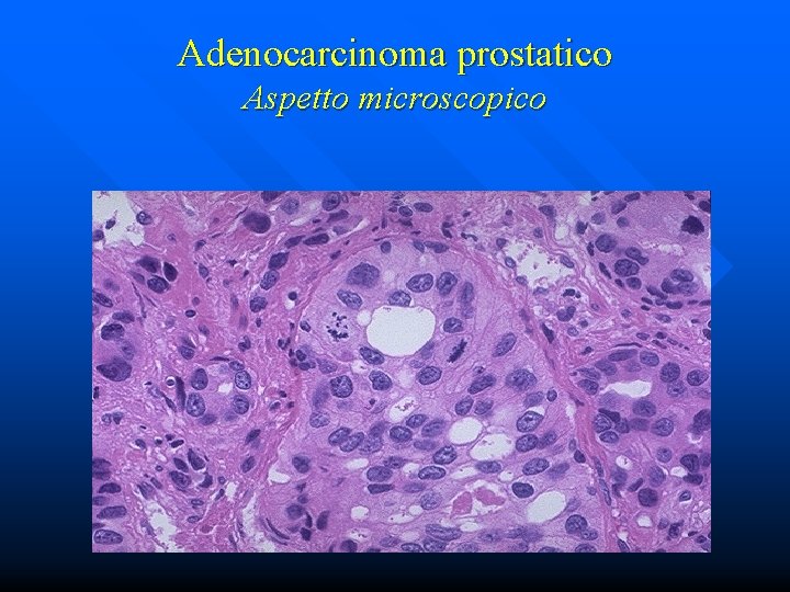 Adenocarcinoma prostatico Aspetto microscopico 