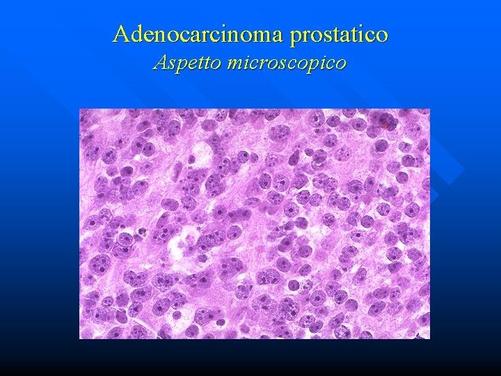 Adenocarcinoma prostatico Aspetto microscopico 